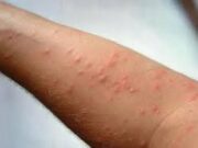 გურჯაანის მუნიციპალიტეტში მუნის ორი შემთხვევა გამოვლინდა