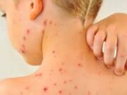 გურჯაანის მუნიციპალიტეტში ჩუდყავილას შემთხვევები გახშირდა